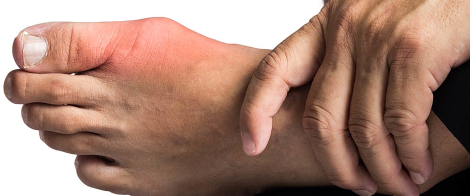 Understanding the Connection Between Gout and Diabetes