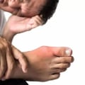 Understanding the Connection Between Exercise and Gout Attacks