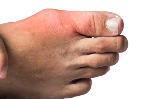 Understanding the Connection Between Gout and Diabetes