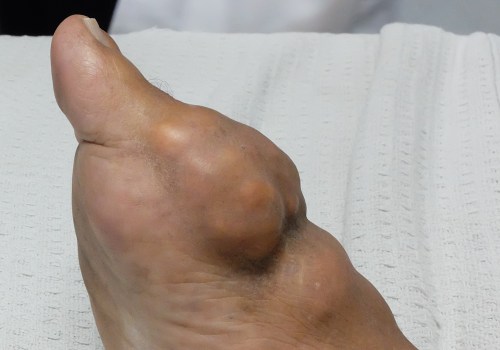 Understanding the Relationship Between Ozempic and Gout
