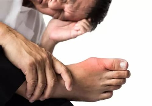 Understanding the Connection Between Exercise and Gout Attacks