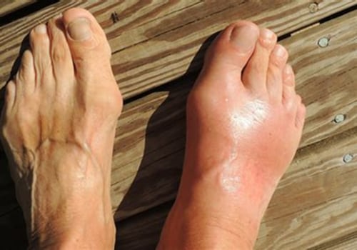 Uncovering Hidden Gout Triggers: What Your Doctor Might Overlook