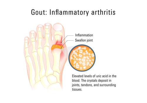 Understanding Exercise After a Gout Attack: Timing and Recommendations