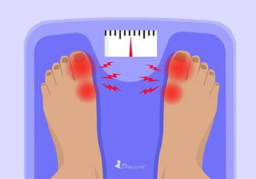 Understanding the Connection Between Gout and Obesity